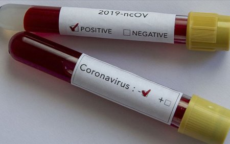 Azərbaycanda daha 30 nəfərdə koronavirus aşkarlandı - 